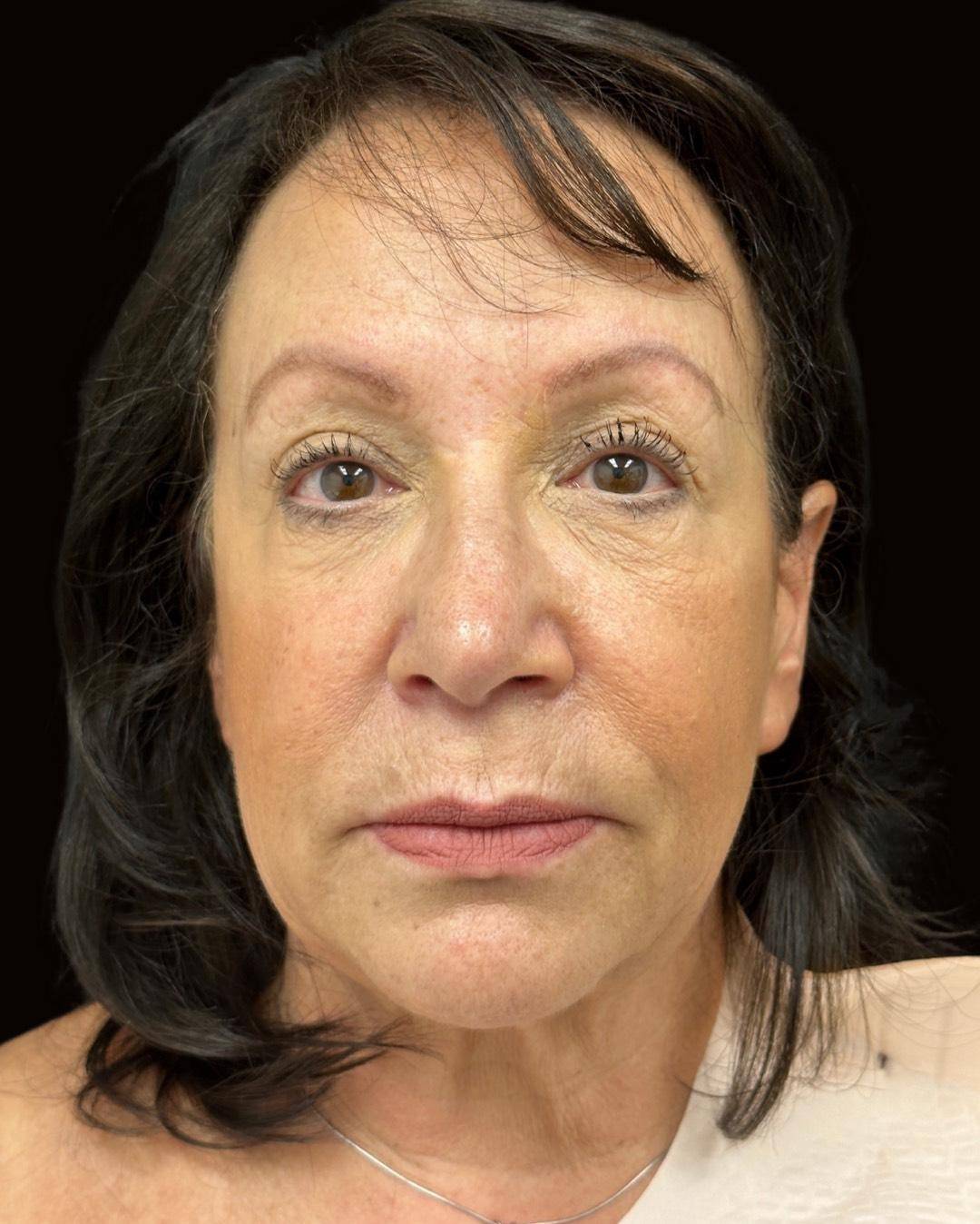 Mini Facelift with Belpharoplasty and Fat Grafting Before