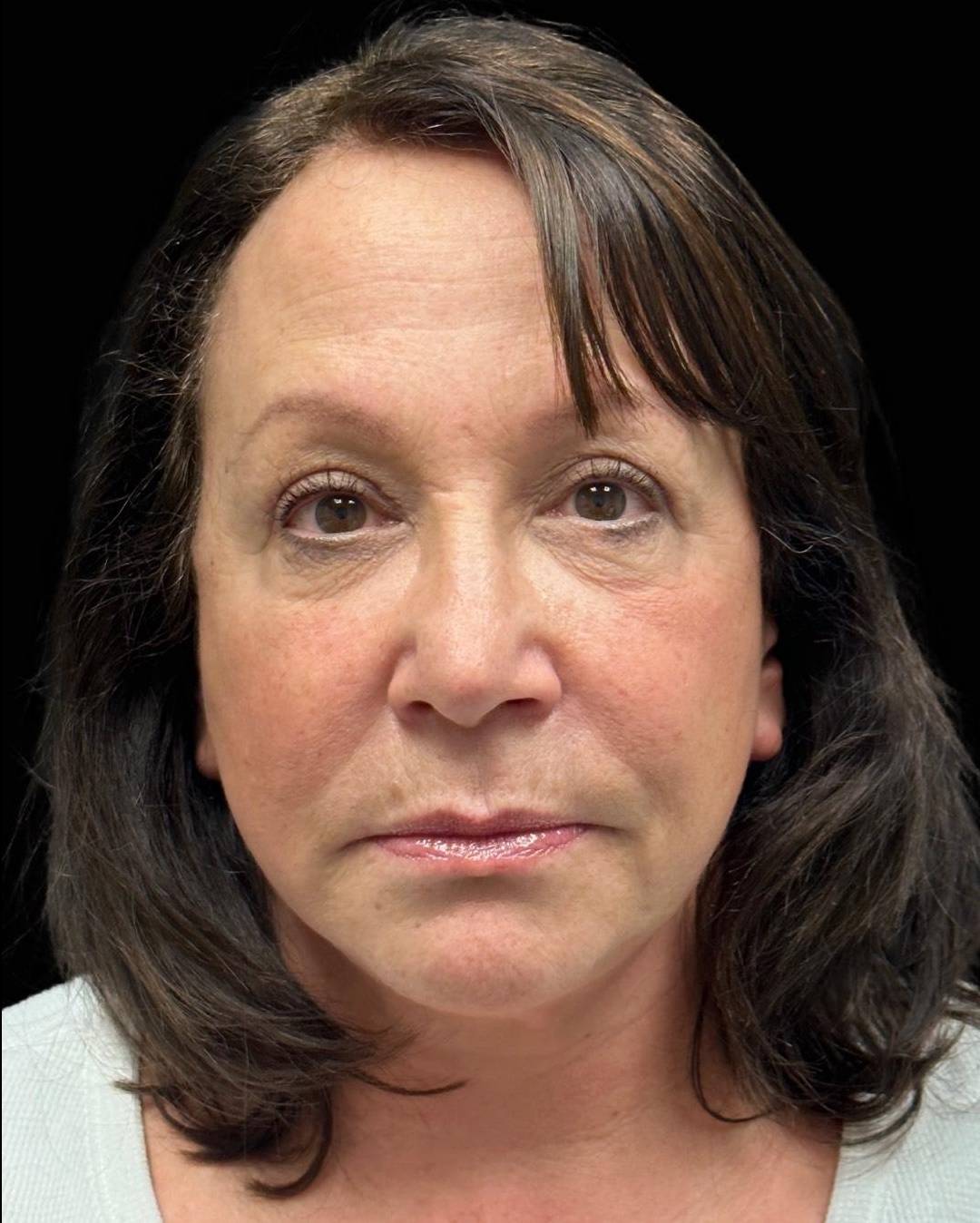 Mini Facelift with Belpharoplasty and Fat Grafting After
