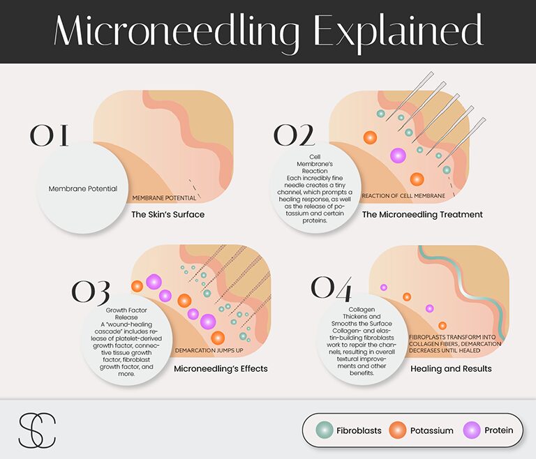 Discover how microneedling at New Jersey’s Sood Center prompts skin-improving wound repair.